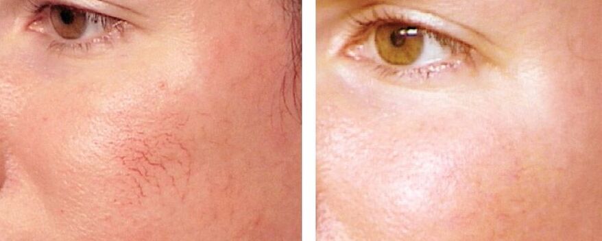 Ngaleungitkeun Rosacea