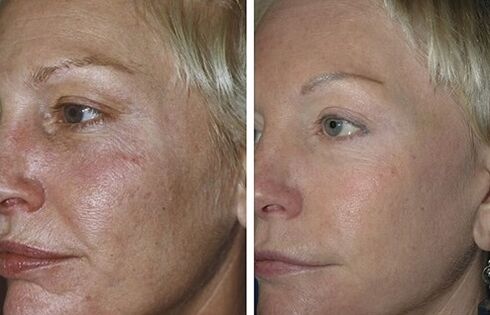 rejuvenation laser fractional saméméh jeung sanggeus poto