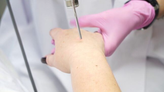 Laser rejuvenation kulit leungeun
